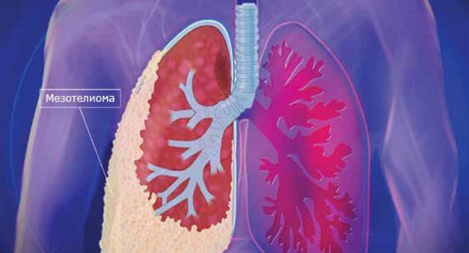 Mezotelyoma və HIPEC müalicəsi